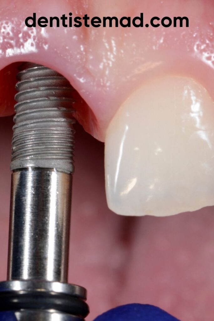 Jaw bone drilling for implant placement