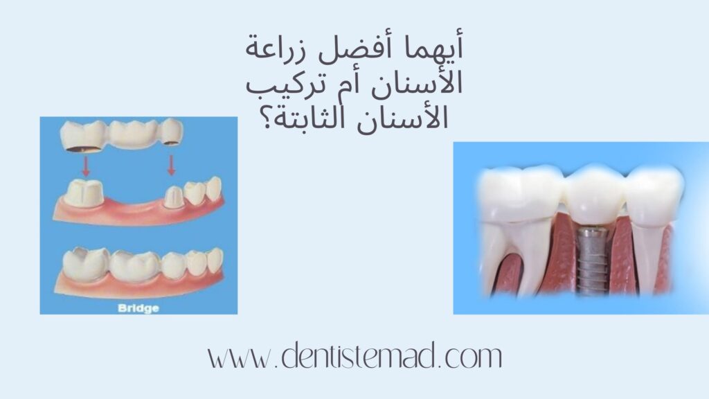 أيهما أفضل زراعة الأسنان أم تركيب الأسنان الثابتة؟