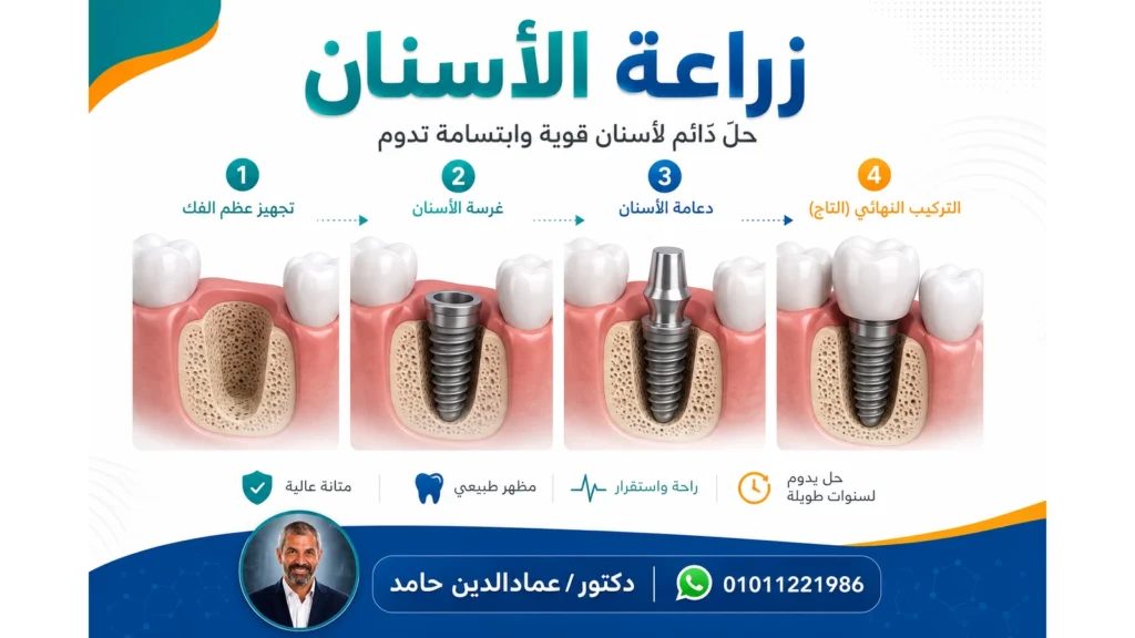 مراحل زراعة الأسنان من الغرسة وحتى تركيب التاج النهائي