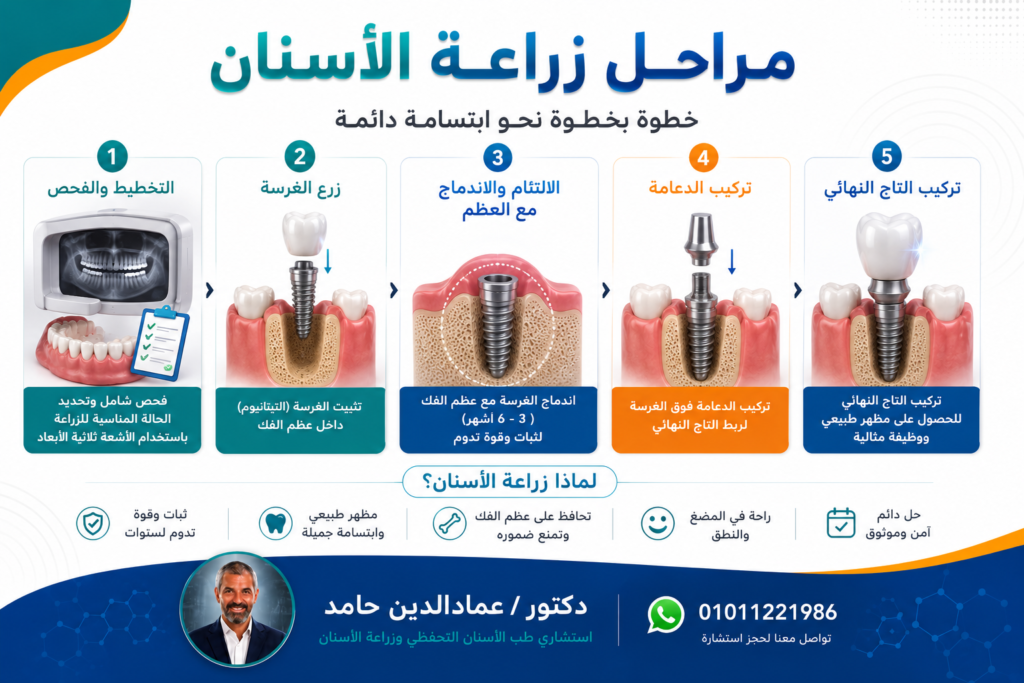مراحل زراعة الأسنان تشمل الفحص والتخطيط ثم زرع الغرسة وإنتظار حدوث الإلتئام والإندماج مع عظام الفك ثم تركيب الدعامة ثم تركيب التاج